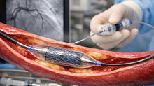 angioplasty