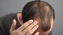 hair-loss